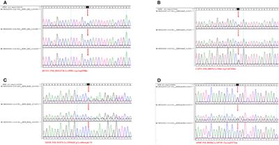 Epilepsy Combined With Multiple Gene Heterozygous Mutation